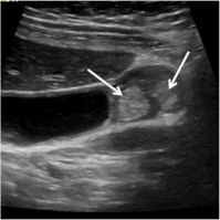 Adenomyomatosis: That Other Cause of RUQ Pain