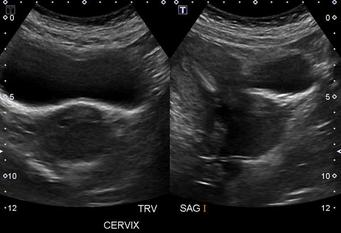 The importance of cervical assessment
